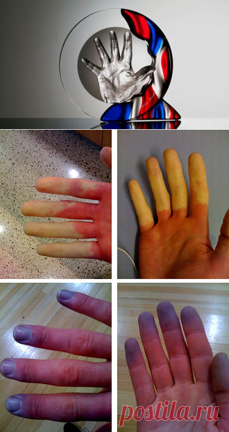 Феномен Рейно, меняющий цвет кожи рук