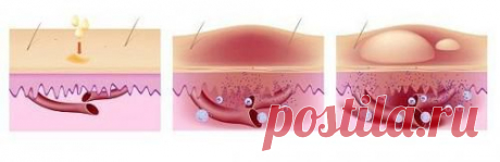 Как лечить крапивницу народными средствами.
