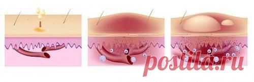 Как лечить крапивницу народными средствами.