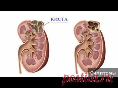 Киста почки. Как лечить кисту почки.