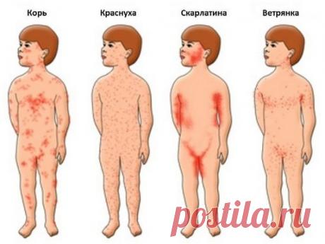 Сыпь при кори, скарлатине, краснухе и ветранке