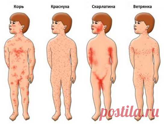 Сыпь при кори, скарлатине, краснухе и ветранке
