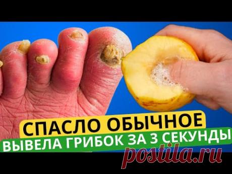 МОЩНЕЙШИЙ РЕЦЕПТ: ГРИБОК Ногтей ИСЧЕЗНЕТ НАВСЕГДА!