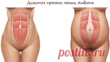 ДИАСТАЗ: КАК УСТРАНИТЬ РАСХОЖДЕНИЕ БРЮШНЫХ МЫШЦ ПОСЛЕ РОДОВ | Женский журнал