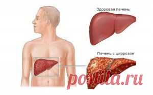 цирроз печени
