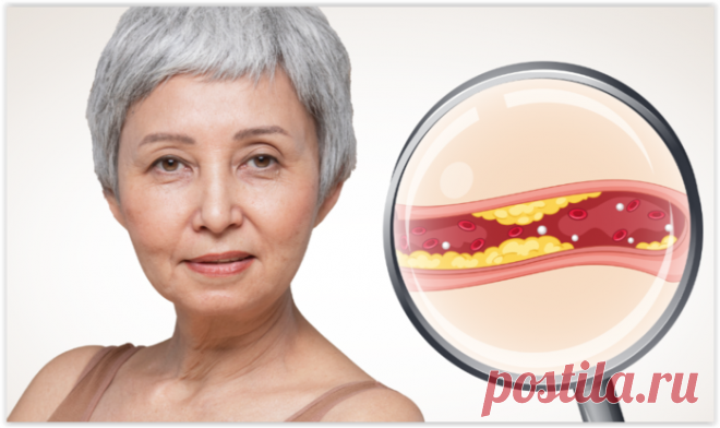 Как снизить плохой холестерин, если еда не помогает