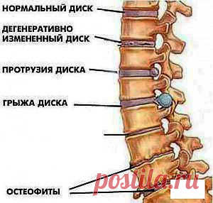 остеохондроз | = Знахаръ=