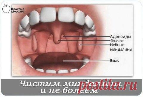 Очищение гланд