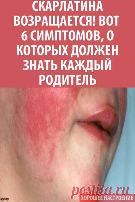 Скарлатина — это острое инфекционное заболевание, представляющее собой сочетание ангины с мелкой сыпью пурпурного цвета по всему телу. Сопровождается уплотнением лимфатических узлов, шелушением кожи. Болезнь опасна, так как заболевание часто протекает тяжело и имеет осложнения.