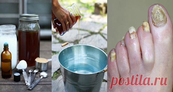 Esta receta súper fácil de 2 ingredientes eliminará los hongos de las uñas para siempre &#8211; Hoy En Belleza