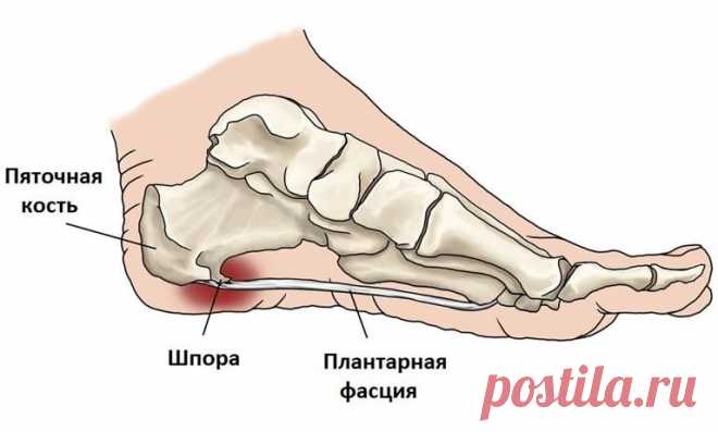 Пяточная шпора: 17 эффективных рецептов народной медицины