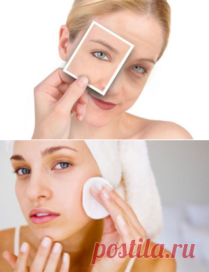 Отеки под глазами после биоревитализации: как убрать и почему появляются