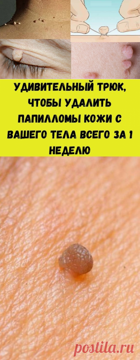 Удивительный трюк, чтобы удалить папилломы кожи с Вашего тела всего за 1 неделю - Счастливые заметки