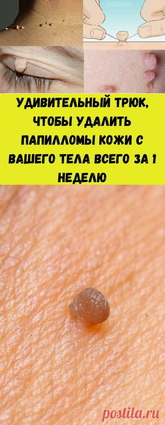 Удивительный трюк, чтобы удалить папилломы кожи с Вашего тела всего за 1 неделю - Счастливые заметки