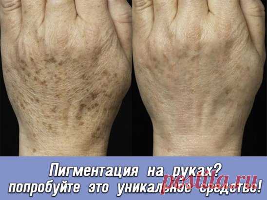 Как избавиться от пигментных пятен на руках и лице? 
Популярное мнение, что избавиться от веснушек и других пигментных пятен невозможно — прочно засело в головах современных людей. И хотя это утверждение устарело еще в начале 2000-х годов, большинство до сих пор верит, что для очищения кожи не существует способов. 
Но исследования в области очищения кожи от погментации не стоят на месте. Одно из недавних открытий – крем Miracle Glow с китайским кордицепсом, который помогает избавиться от п