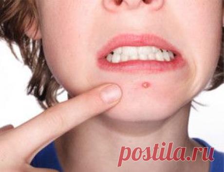 Борьба с угревой сыпью | vkusnyymir