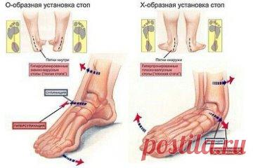 Что происходит при плоскостопии? 
 
Человеческая стопа обладает уникальным свойством — она работает как амортизатор, то есть пружинит. Ни одно, даже самое высоко прыгающее и быстро бегающее животное, типа кенгуру или ягуара, не может похвастаться этой удивительной способностью. Пружинит стопа за счет конструкции свода, которую поддерживает система связок и мышц. Когда этот мышечно-связочный механизм по каким-то причинам ослабевает, развивается плоскостопие. 
 
Уплощенная с...