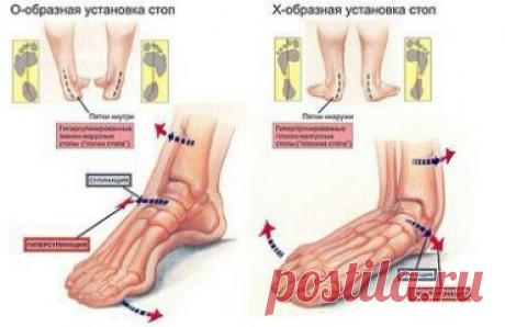 Что происходит при плоскостопии? 
 
Человеческая стопа обладает уникальным свойством — она работает как амортизатор, то есть пружинит. Ни одно, даже самое высоко прыгающее и быстро бегающее животное, типа кенгуру или ягуара, не может похвастаться этой удивительной способностью. Пружинит стопа за счет конструкции свода, которую поддерживает система связок и мышц. Когда этот мышечно-связочный механизм по каким-то причинам ослабевает, развивается плоскостопие. 
 
Уплощенная с...