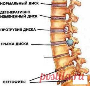 Остеохондроз лечение народными методами | Домашний лекарь