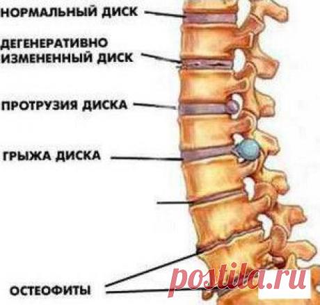 Остеохондроз лечение народными методами | Домашний лекарь