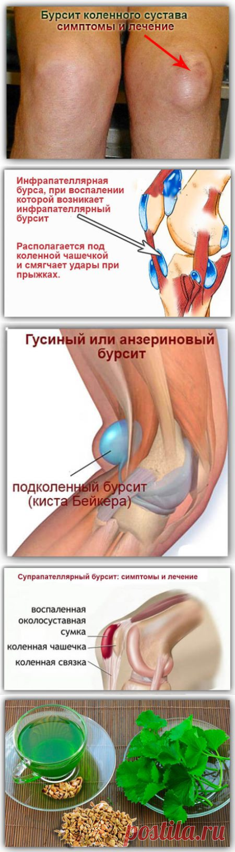 Бурсит коленного сустава симптомы и лечение, виды бурсита