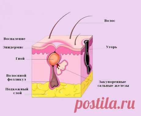 Это должен знать каждый! Акне является одним из наиболее распространенных заболеваний кожи, которым страдают почти 85 процентов людей в возрасте от 12 до 24 лет. Акне является признаком дисбаланса в вашем теле и его можно наиболее эффективно устранить с помощью разумных изменений в рационе питания и образе жизни.