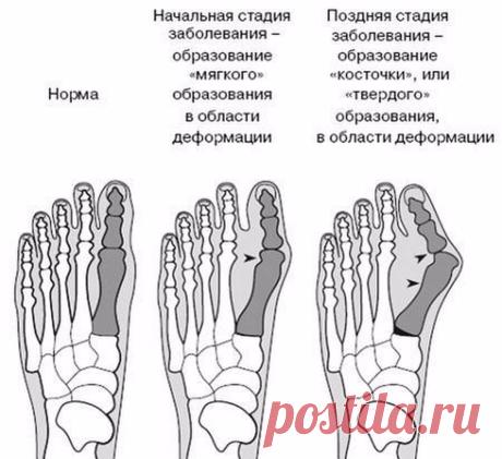 Эффективные упражнения от косточек на ногах Экология здоровья: Появление вальгусной деформации стопы, или так называемых «косточек» на ногах, может очень сильно беспокоить обладателя этого неприятного заболевания, доставляя дискомфорт во время ходьбы и порождая определенные проблемы при подборе удобной обуви. Более того, игнорирование симптомов может привести к осложнениям – появлению артроза стопы, бурсита и даже остеохондроза.