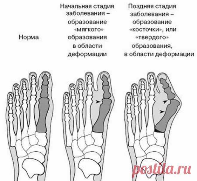 Эффективные упражнения от косточек на ногах Экология здоровья: Появление вальгусной деформации стопы, или так называемых «косточек» на ногах, может очень сильно беспокоить обладателя этого неприятного заболевания, доставляя дискомфорт во время ходьбы и порождая определенные проблемы при подборе удобной обуви. Более того, игнорирование симптомов может привести к осложнениям – появлению артроза стопы, бурсита и даже остеохондроза.