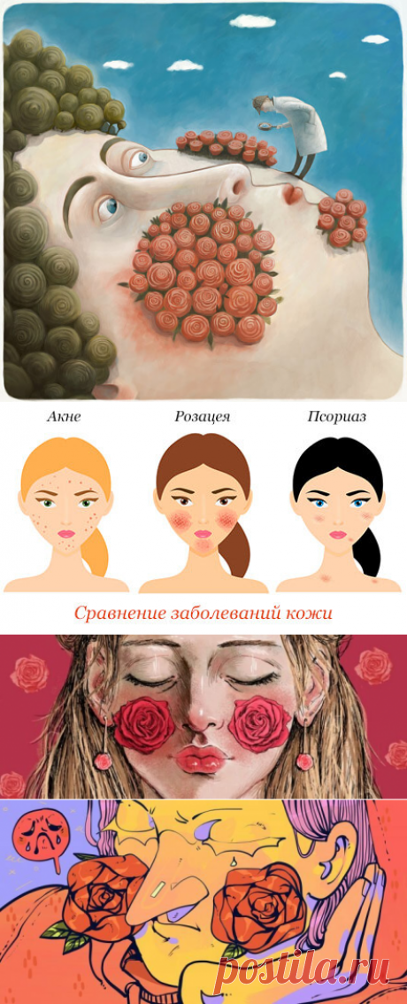 Питание при розацеа: список доброй и злой еды
  Что такое розацеа на лице Это хроническое заболевание кожи: розовые угри на поверхности лица. Чаще бывает от повышенной чувствительности сосудов, реагирующих на воздействия раздражителей. Причины: наследственность; солнце, ветер, сильный мороз; заболевания желудочно-кишечного тракта; эндокринные проблемы; неправильное питание; нарушения в работе...
Читай дальше на сайте. Жми подробнее ➡