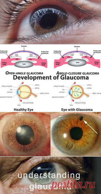 Glaucoma – Google Поиск