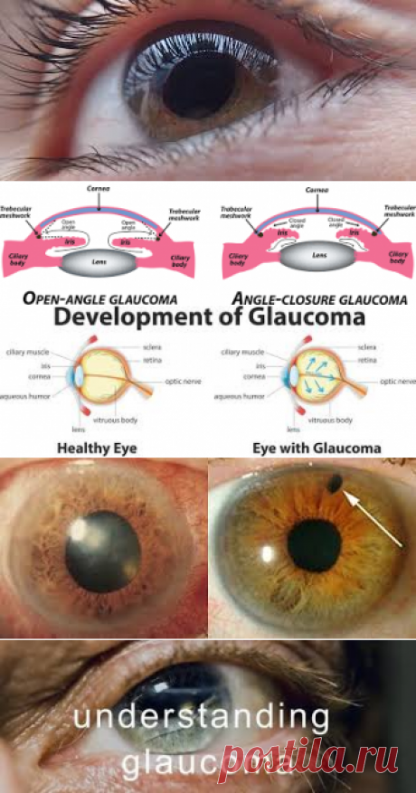 Glaucoma – Google Поиск
