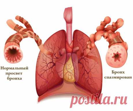 Бронхит.-РЕЦЕПТЫ ЛЕЧЕНИЯ