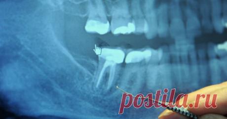 Эту процедуру у стоматолога делали 97% онкобольных! Делаем выводы! Слышали когда-нибудь, как говорят "Все болезни у тебя в голове"? Оказывается, это не просто поговорка. Источник хронической болезни может быть в вашей полости рта. Такая невинная процедура в кабинете стоматолога, когда врач говорит о полной безопасности. Но многолетние исследования приводят к другому результату. Это вредно для вашего здоровья! Ежедневно в Соединённых Штатах около 50 тыс. человек выполняют д...