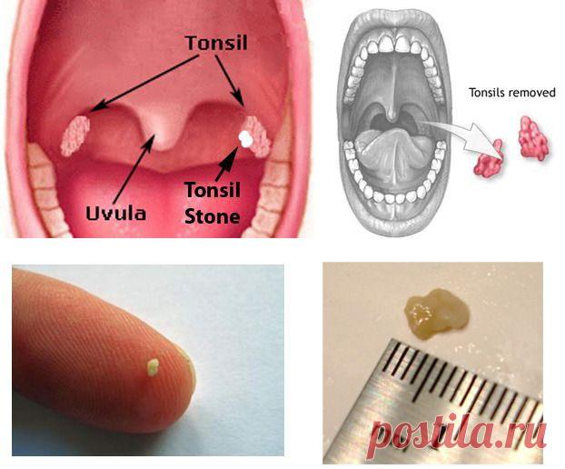 Комочки с ужасным запахом, которые появляются во рту