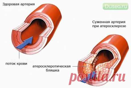 Kрупнейшая афера XX века. Холестерин.