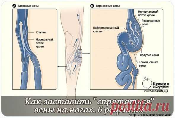 Как заставить ''спрятаться'' вены на ногах. 6 рецептов