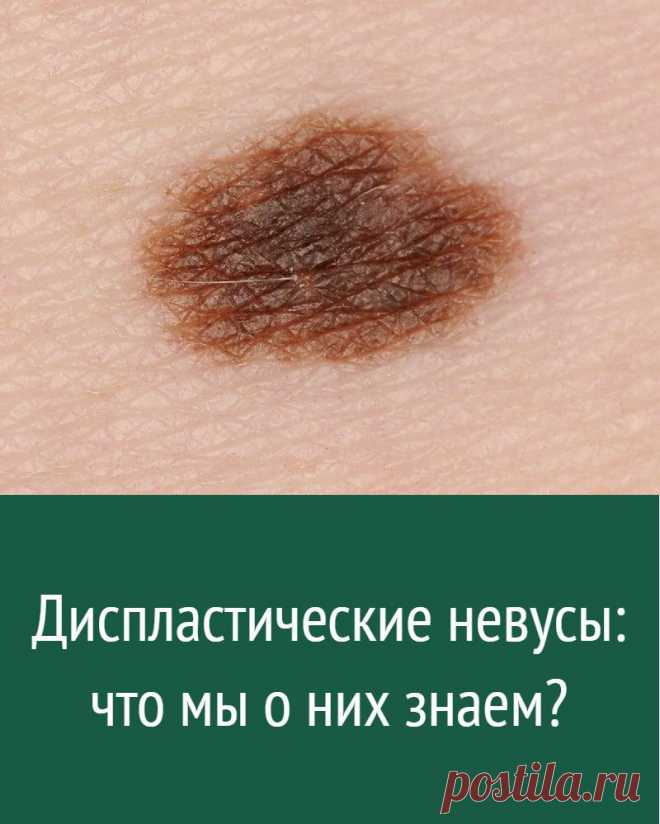 Диспластические невусы: что мы о них знаем?