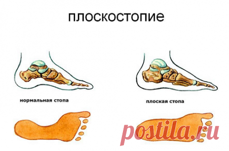 Плоскостопие.Правильная обувь для вашей стопы