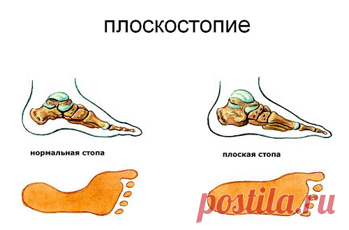 Плоскостопие.Правильная обувь для вашей стопы