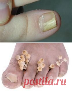 ЛЕЧЕНИЕ ГРИБКА НАРОДНЫМИ СРЕДСТВАМИ