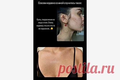 Дина Саева показала лицо и тело в прыщах. Российская блогерша и модель таджикского происхождения Дина Саева показала лицо и тело в прыщах. На размещенных кадрах инфлюэнсерша продемонстрировала лицо в профиль, а также зону декольте, где появились высыпания. При этом она предположила, что покраснения могли возникнуть после съемок бьюти-видео.