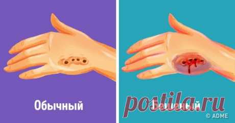 Как отличить укус бешеного животного.Если вас покусали, сразу же промойте рану теплой водой с мылом. Даже если у животного не было бешенства, укусы легко могут занести инфекцию.Рана при укусе бешеного животного будет долго кровоточить, потом покраснеет и сильно опухнет. Затем появится сильный зуд, повысится температура и появится сильная раздражительность.Вся болезнь бешенства протекает 4–7 дней и приводит к смерти. Поэтому важно посетить больницу и поставить вакцину в теч...