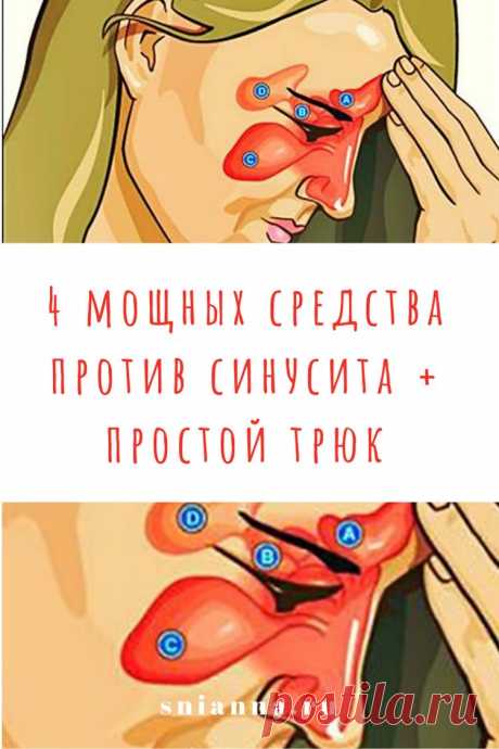 4 мощных средства против синусита + простой трюк, который очистит пазухи всего за 20 секунд! ➡️ Кликайте на фото, чтобы прочитать статью полностью