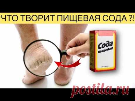 Результат мгновенный! Грибок и мозоли отвалились, лишь окунуть ноги в раствор сода с …
