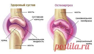 Болят колени, лечение народными средствами:
Если болят колени, нужно взять лист хрена, окунуть в кипяток, приложить на 2-3 часа к коленям. Листья хрена хорошо вытягивают соли и боль проходит. Курс лечения – 7 дней.

Если травмированы суставы на ногах: на ночь делать компрессы из раствора хозяйственного мыла.

Возьмите денатурат и керосин в равных пропорциях, слейте в стеклянную банку, положите туда 3-4 стручка свежего жгучего перца. Банку плотно закройте, поставьте настаив...