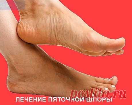 Народные рецепты пяточные шпоры