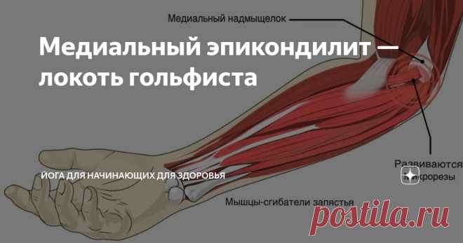 Медиальный эпикондилит — локоть гольфиста Статья автора «Йога для начинающих для здоровья» в Дзене ✍:  Медиальный эпикондилит, широко известный как 