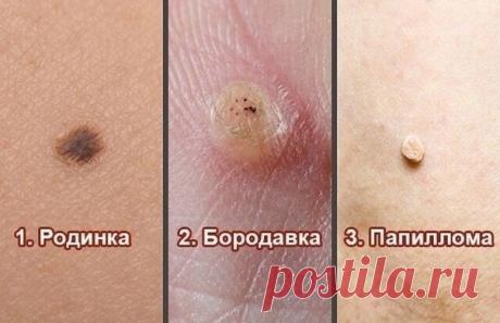 ПАПИЛЛОМЫ-РОДИНКИ-БОРОДАВКИ