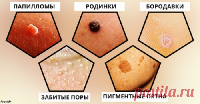 Вот как избавиться от угрей, черных точек и бородавок не выходя из дома
К сожалению, проблемная кожа — это напасть, не зависящая от возраста, пишет Providr. Это может быть следствием гормональных изменений, а может быть вызвано болезнью или дефицитом каких-нибудь веществ в организме. Бывает также, что вам просто хочется избавиться от накожных образований по чисто эстетической причине. Лучший...
Читай пост далее на сайте. Жми ⏫ссылку выше