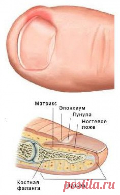 Вросший ноготь на большом пальце ноги. Как избавиться?